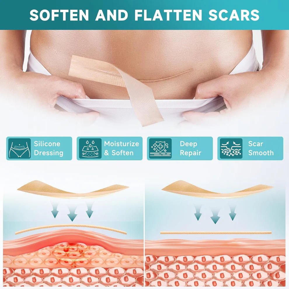Derma Silicone Tape – Fast & Painless Scar Removal Solution At Home - Blushbae