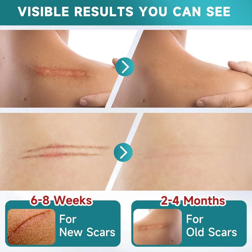 Derma Silicone Tape – Fast & Painless Scar Removal Solution At Home - Blushbae
