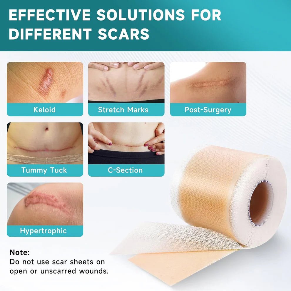 Derma Silicone Tape – Fast & Painless Scar Removal Solution At Home - Blushbae