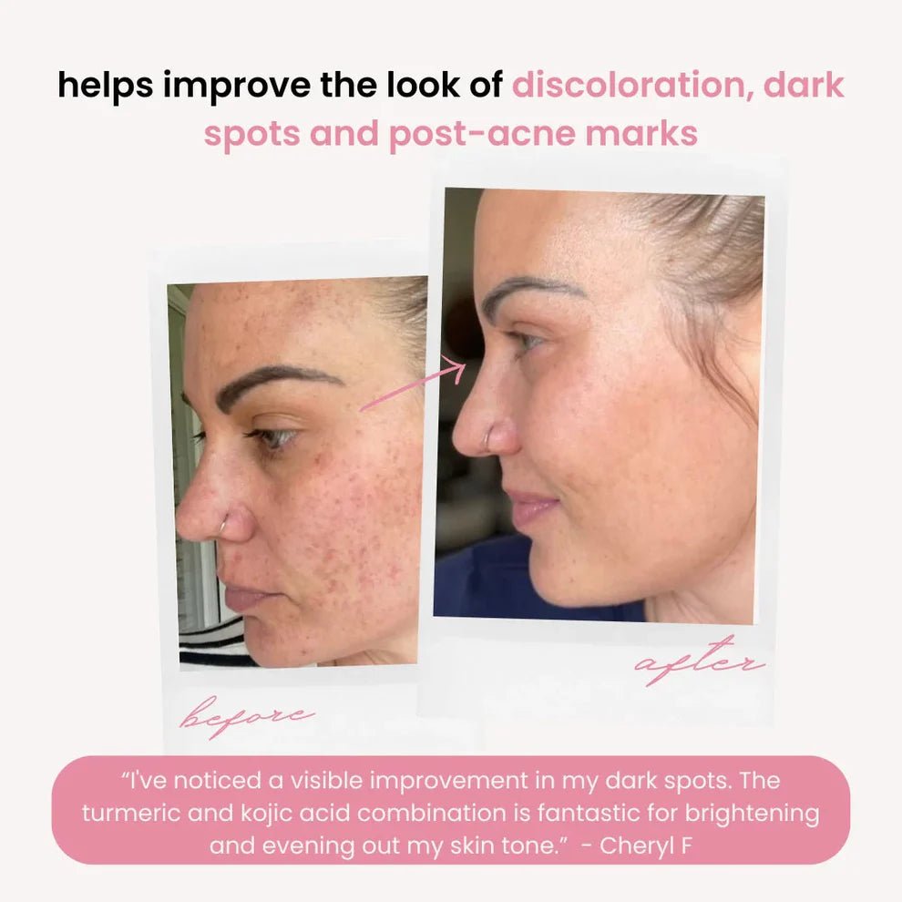 Turmeric & Kojic Acid Pads - Blushbae